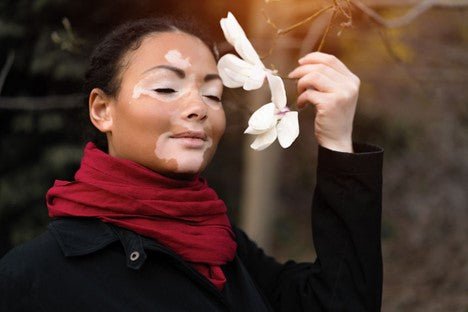 What is vitiligo?